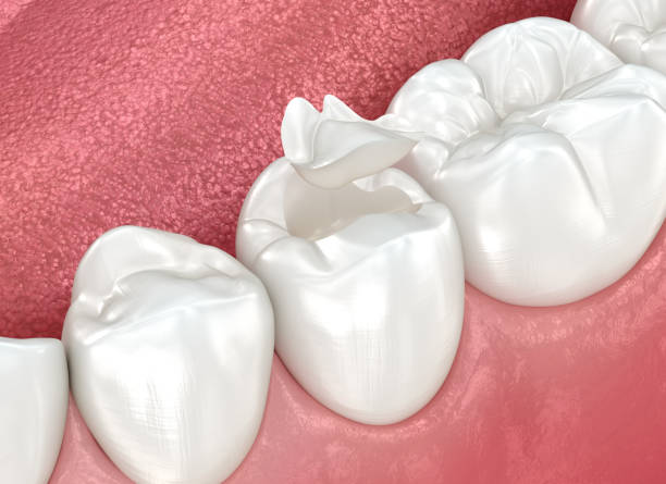 Dental Inlays and Onlays in Columbia, TN